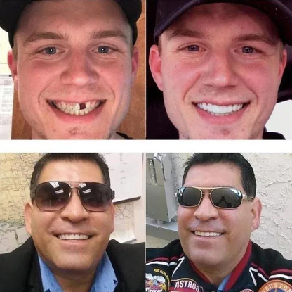 Perfect Smile - Adjustable Snap-On Dentures (2023 Edition)